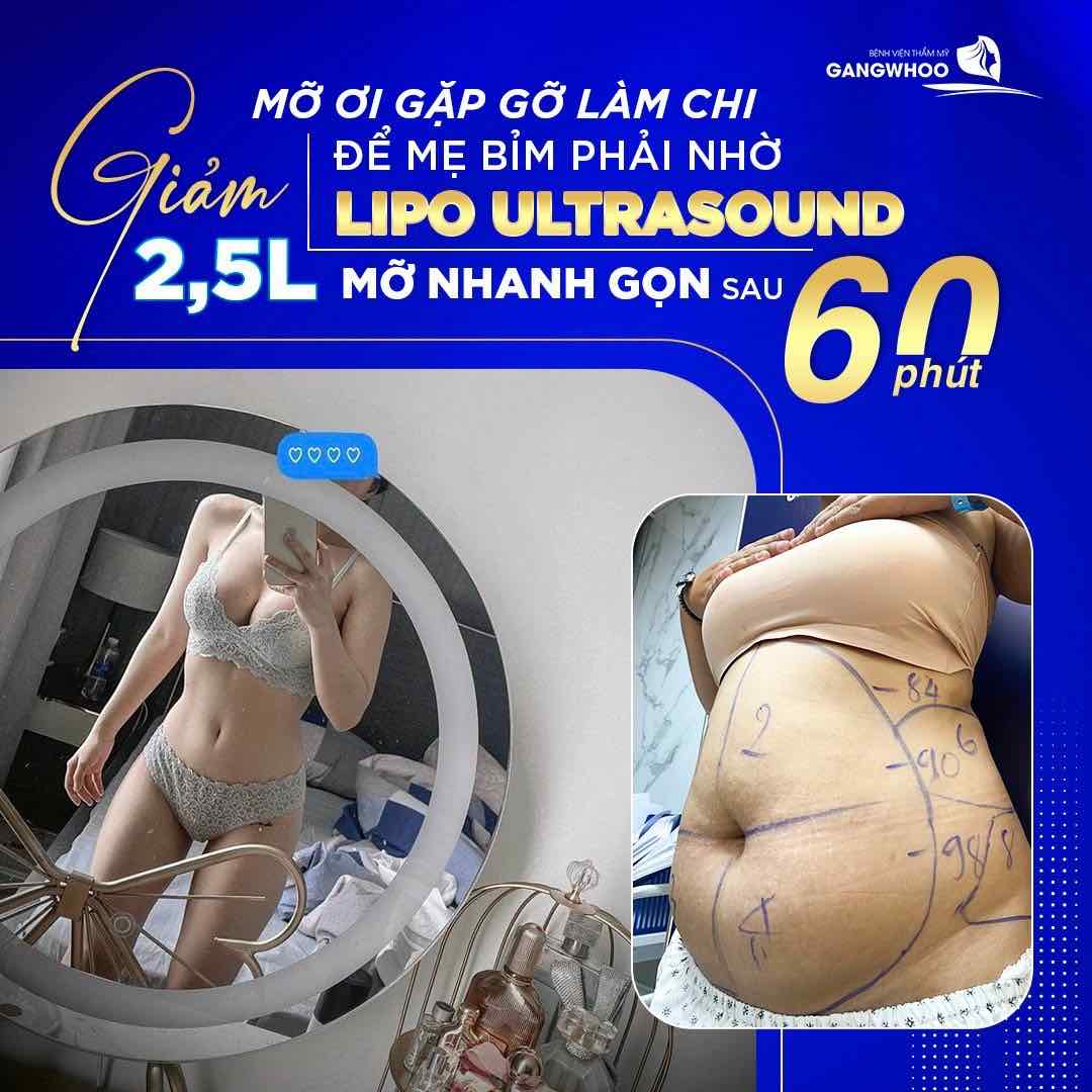 Giảm mỡ tức thì chỉ 60 phút với công nghệ giảm mỡ Lipo Ultrasound
