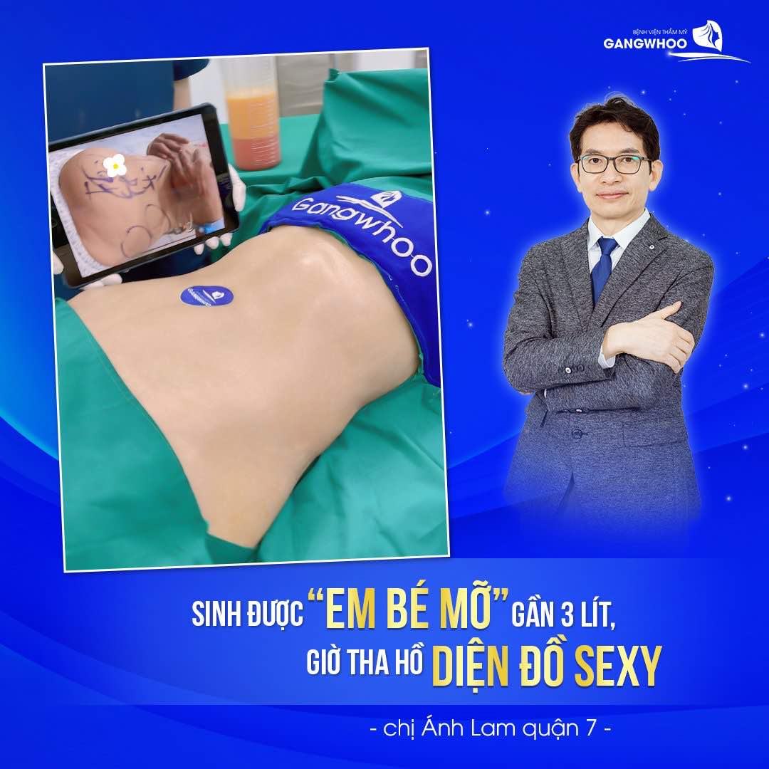 Hút mỡ bằng phương pháp Lipo Ultrasound được yêu thích tại BVTM Gangwhoo