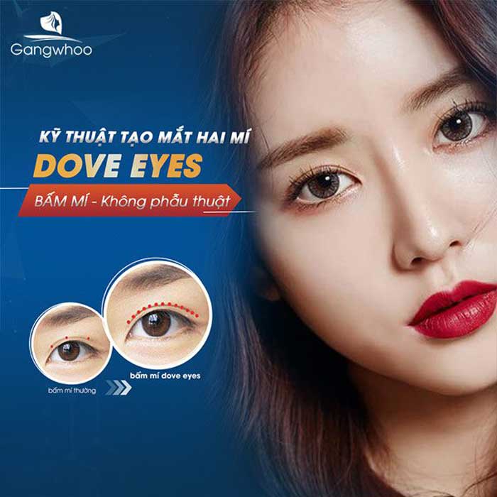 Bấm mí Dove Eye - Trend mắt bồ câu hot nhất