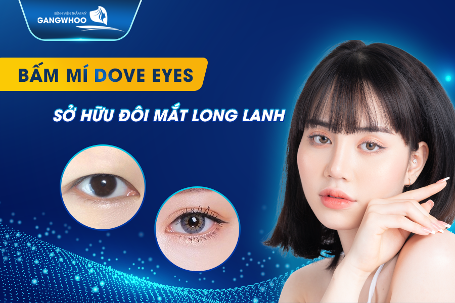Bấm mí Dove Eyes có gì khác biệt?