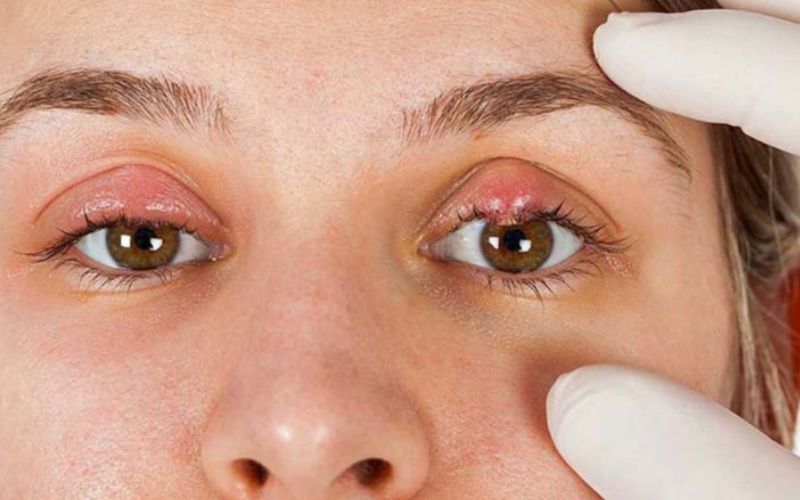 Nhiễm trùng là biến chứng nguy hiểm của cắt mí mắt