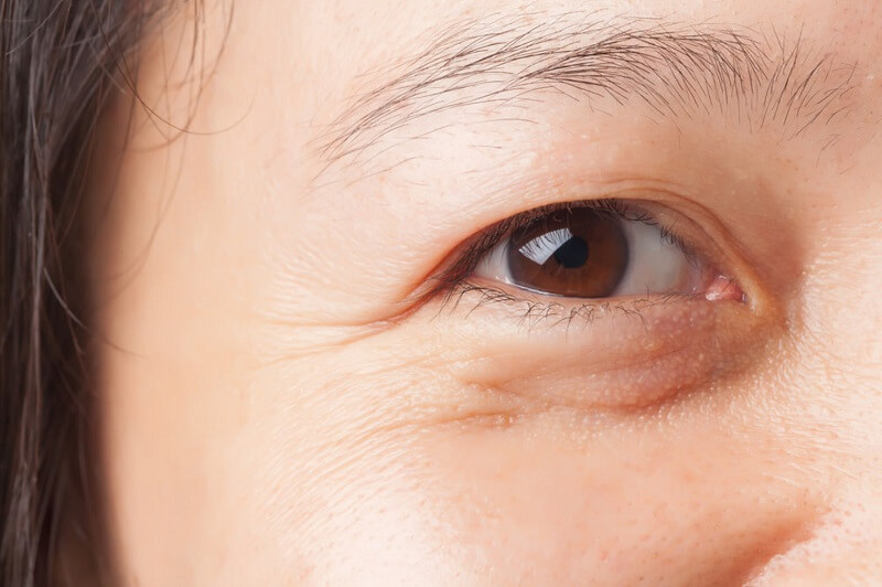 Cắt da thừa mí mắt phù hợp với khách hàng có đôi mắt bị tích tụ nhiều da thừa, che mất tầm nhìn.