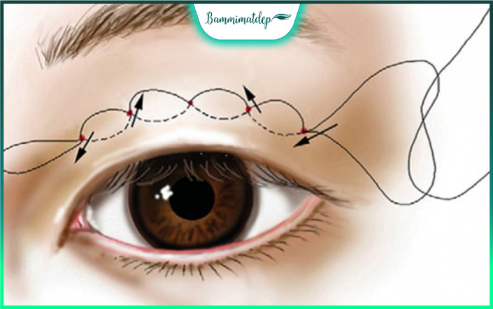 Bấm mí mắt giúp bạn khắc phục nhiều vấn đề khuyết điểm mắt