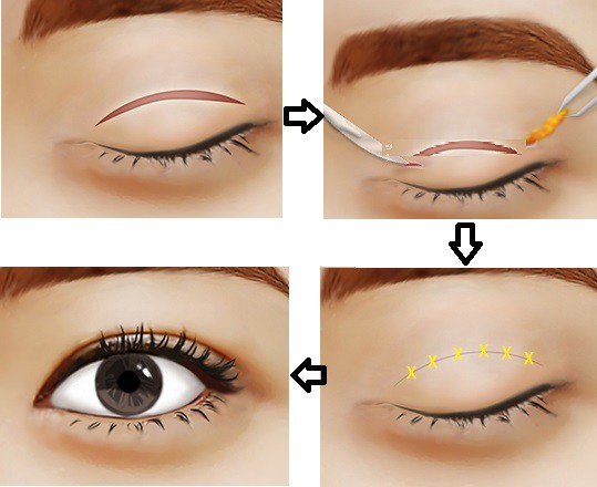 Cắt mí mắt là phương pháp làm đẹp được xếp vào nhóm tiểu phẫu