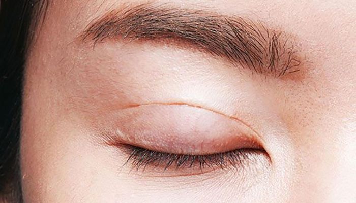 Sẹo Cắt Mí: Nguyên Nhân Và Cách Điều Trị Sẹo Mí Mắt Hiệu Quả