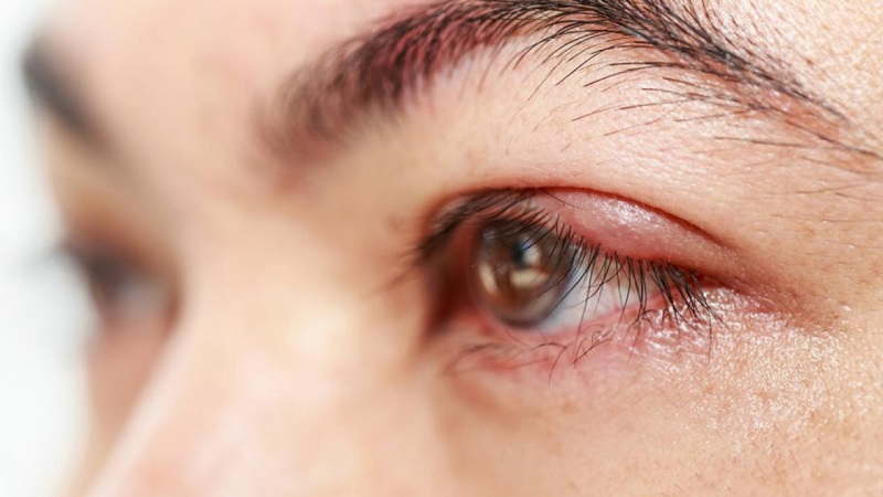 Sưng bầm mí mắt sẽ dần giảm và chấm dứt sau 3-5 ngày, tùy thuộc vào cơ địa