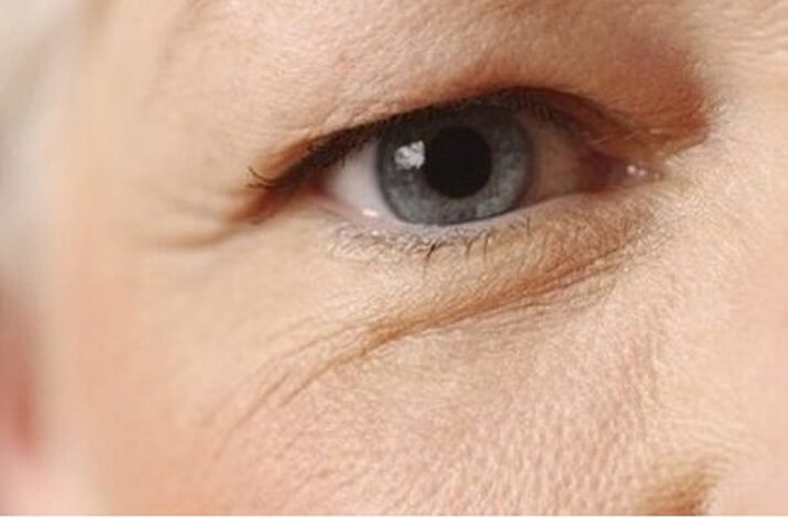 Mỡ mí mắt trên thường xuất hiện ở những người đang bước qua độ tuổi 30 